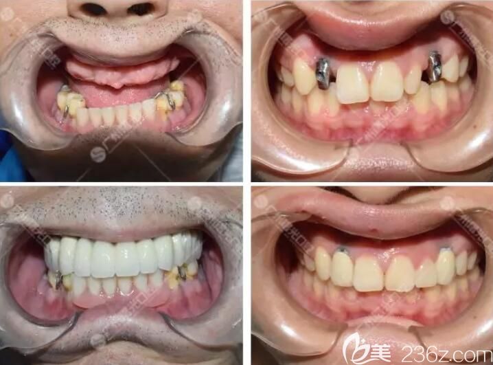 他们都通过在曙光口腔做种植牙,重获新牙 他们都通过在曙光口腔做种植牙,重获新牙