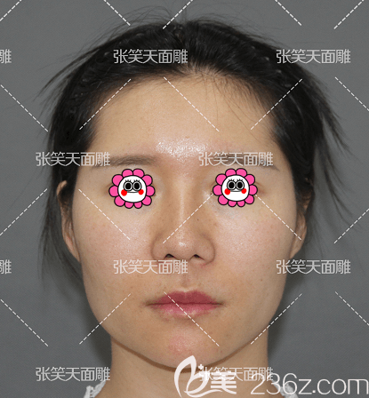 我找北京圣嘉新张笑天做颧骨和下颌角整形前样子 我找北京圣嘉新张笑天做颧骨和下颌角整形前样子