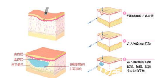 注射玻尿酸的示意图