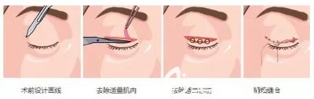 双眼皮手术过程