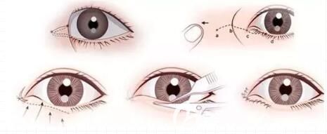 开眼角手术过程
