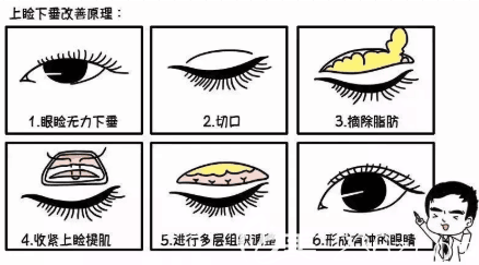 上睑下垂手术过程
