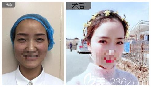 爱尚整形李冉院长眼综合真人案例