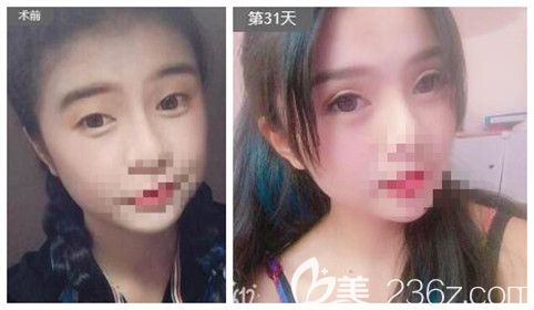 爱尚整形李冉院长眼综合真人案例