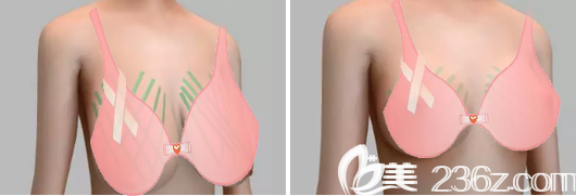 不开刀人工韧带乳房提升手术案例效果图