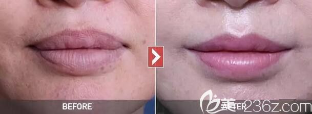 厚唇变薄术前术后效果对比