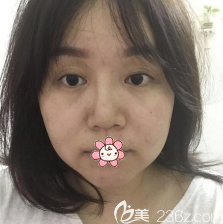 在广州军美做面部吸脂术前照片 在广州军美做面部吸脂术前照片