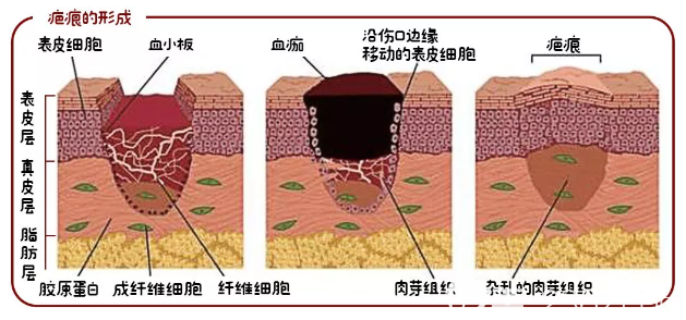 疤痕是怎么形成的