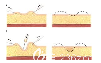 吸脂后凹凸不平的样子