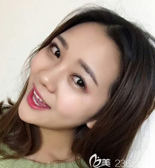 韩国奥斯卡眼睛真人案例