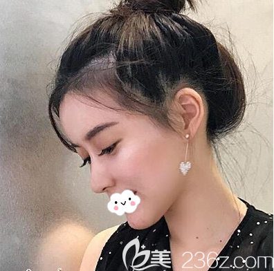 找成都成美李静做了半肋软骨隆鼻后我鼻梁高鼻头有点下勾的困扰终于没了