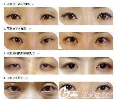 双眼皮失败原因和效果
