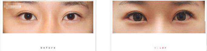 双眼皮修复效果对比图