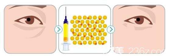 自体脂肪填充泪沟原理