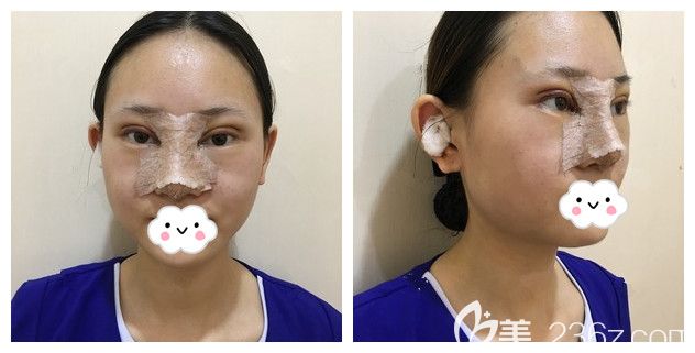 冰敷两天后眼鼻恢复情况 冰敷两天后眼鼻恢复情况