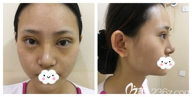 一周拆线眼鼻恢复情况 一周拆线眼鼻恢复情况