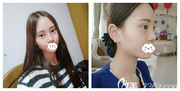 做完硅胶+自体耳软骨隆鼻+翘睫美瞳双眼皮术后半个月恢复 做完硅胶+自体耳软骨隆鼻+翘睫美瞳双眼皮术后半个月恢复