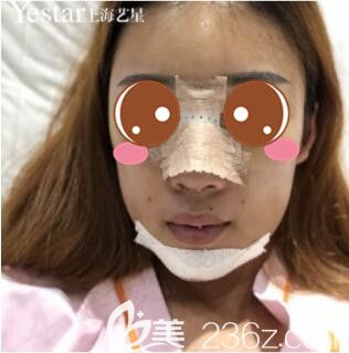 上海艺星唐毅半肋鼻综合+自体脂肪填充下巴真人案例术后第4天