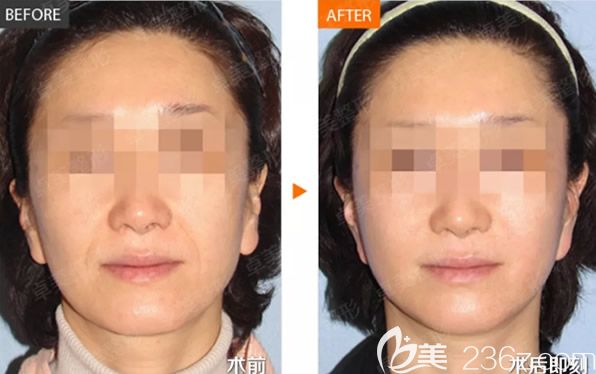 玻尿酸填充法令纹效果