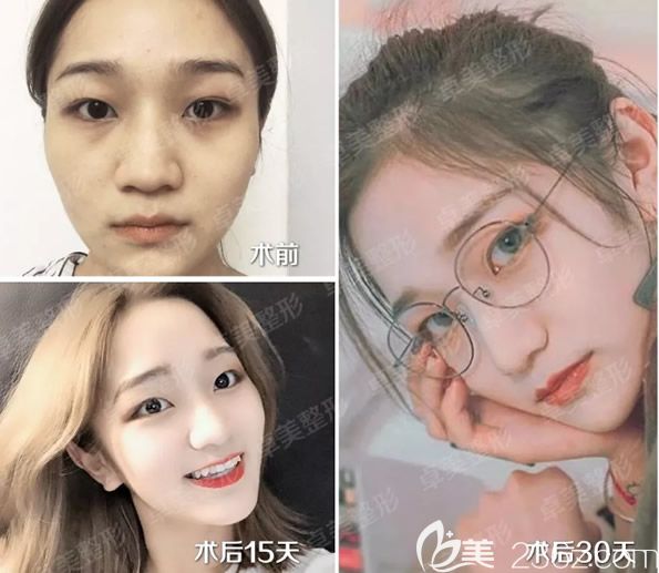 真人全脸脂肪填充前后效果对比照片