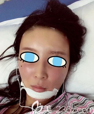 南阳维多利亚面部填充术后即刻