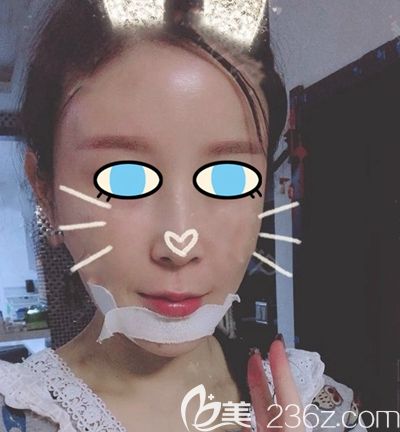 南阳维多利亚面部填充术后第3天