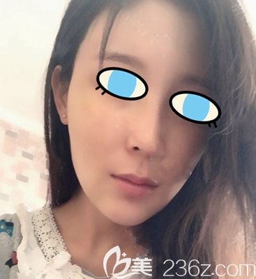 南阳维多利亚面部填充后15天