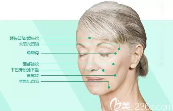 脸部凹陷填充部位示意图