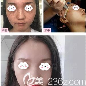 黄媛媛做激光祛斑术前术后对比案例 黄媛媛做激光祛斑术前术后对比案例