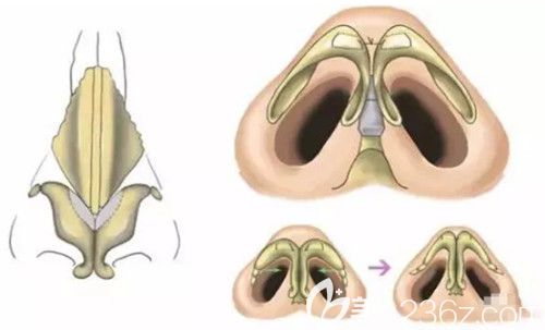 蒜头鼻通过鼻综合改善整体鼻子形状
