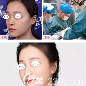 周旭刚做鼻综合整形术后60天鼻子自然挺拔 周旭刚做鼻综合整形术后60天鼻子自然挺拔