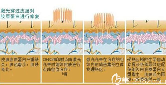 点阵激光祛痘坑原理介绍