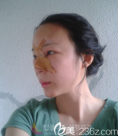 韩国TOPCLASS立体轮廓隆鼻真人案例