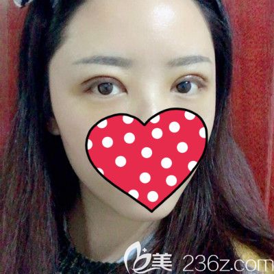 闺蜜到赣州薇琳做全切双眼皮术后第3天