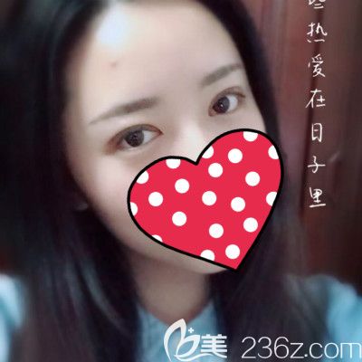 闺蜜到赣州薇琳做全切双眼皮术后第15天效果