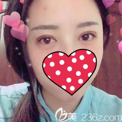 看闺蜜到赣州薇琳医疗美容割双眼皮术后20天效果怎么样