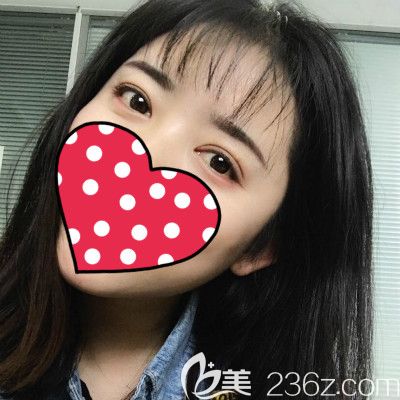 惊呆了!闺蜜到赣州薇琳做全切双眼皮40天后简直像换了一张脸