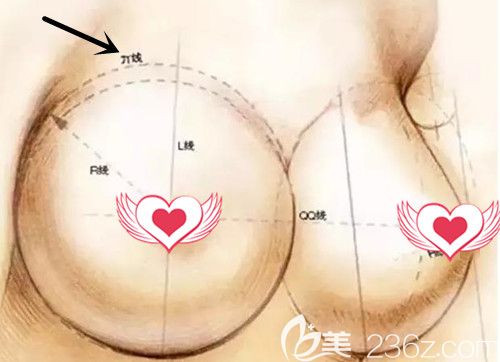 假体隆胸的大小由胸廓宽度决定