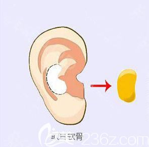取耳软骨示意图 取耳软骨示意图