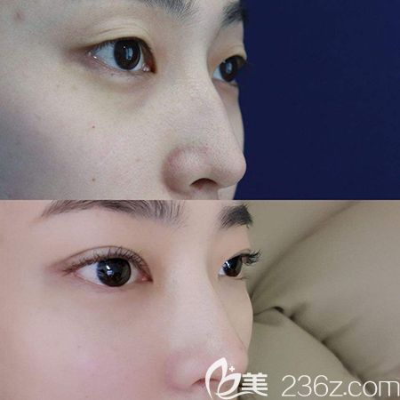 肋软骨隆鼻术后效果对比 肋软骨隆鼻术后效果对比