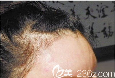 面部自体脂肪填充过量