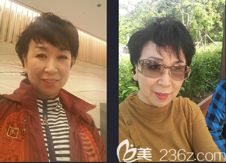 颧脂垫下移 颧脂垫下移