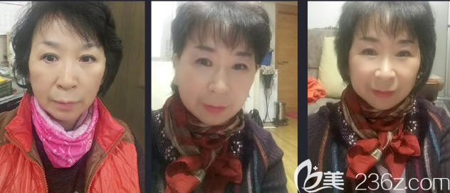 韩国JJ洪镇柱面中部提升术怎么样 韩国JJ洪镇柱面中部提升术怎么样