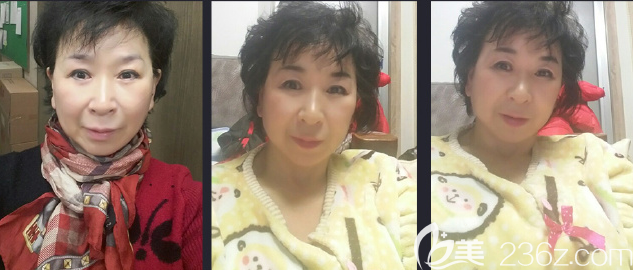 颧脂垫下移显老韩国JJ洪镇柱面中部提升术双眼皮让老阿姨重回18岁