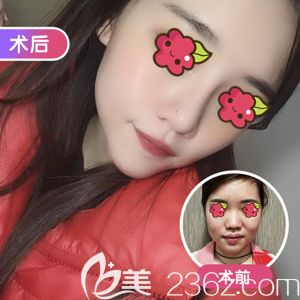 汪福强院长做韩式生科假体隆鼻术前术后对比 汪福强院长做韩式生科假体隆鼻术前术后对比