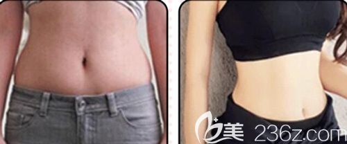 汪洋医生做腰腹吸脂术后30天腰部明显变细 汪洋医生做腰腹吸脂术后30天腰部明显变细