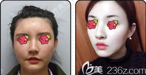 项利姣院长做自体脂肪面部填充术后面部轮廓线变明显 项利姣院长做自体脂肪面部填充术后面部轮廓线变明显