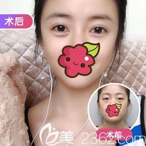 做无痕精雕双眼皮选择项利姣医生 做无痕精雕双眼皮选择项利姣医生