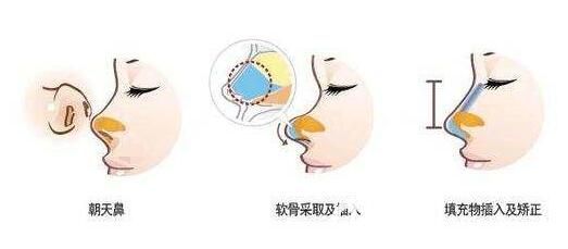 朝天鼻整容需要做鼻综合整形