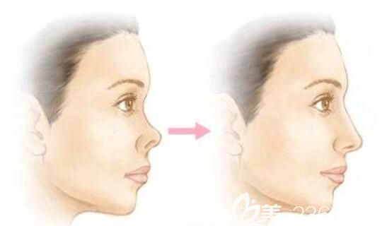 朝天鼻整容前后蜕变